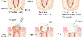 Root canal procedure
