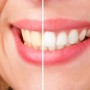 Teeth whineting