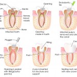 Dental root canal procedure