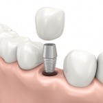Dental implants with Fixed Prosthesis