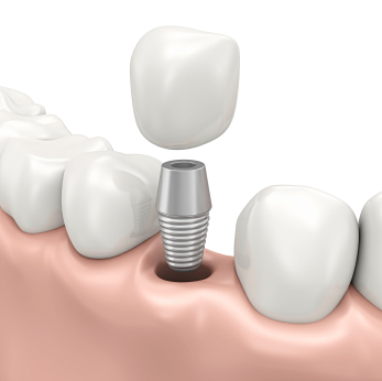 Fixed prosthesis on dental implants