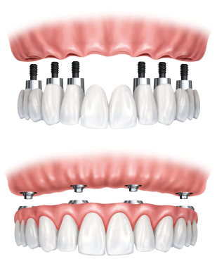 Dental prosthesis on implants
