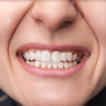 Dental Comestic Restoration