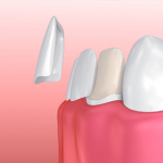 Dental Porcelaine Veneers