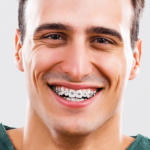 Orthodontic Treatment in Montreal