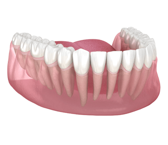 Periodontics - Montreal Dental Clinic